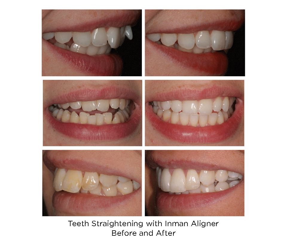 Adult Orthodontics using Inman Aligner