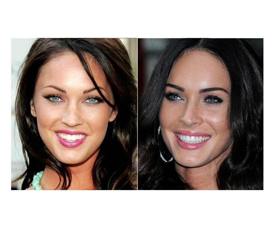 dental veneers celebrity smile transformation