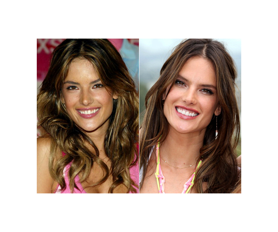 before and after of celebrity dental veneers