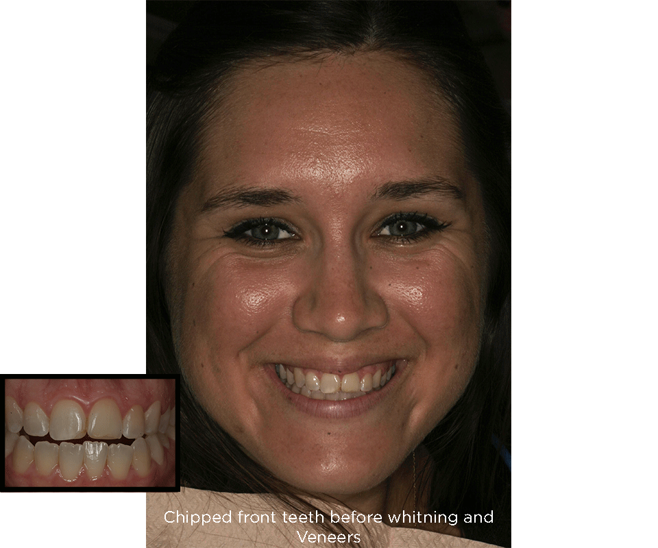 chipped front teeth before porcelain veneers treatments