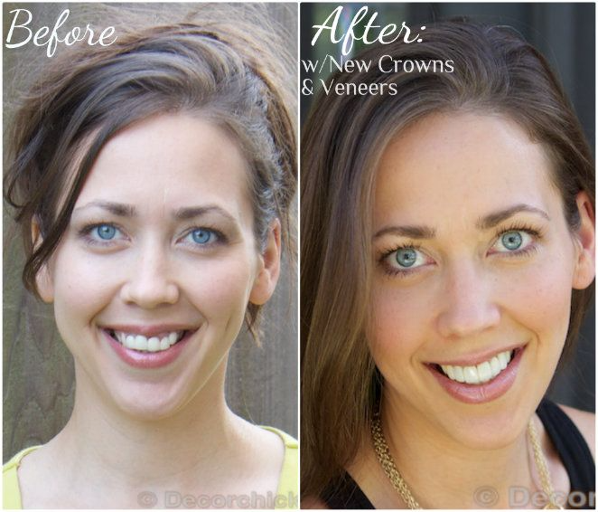 Smile Makeover with dental veneers and crwons