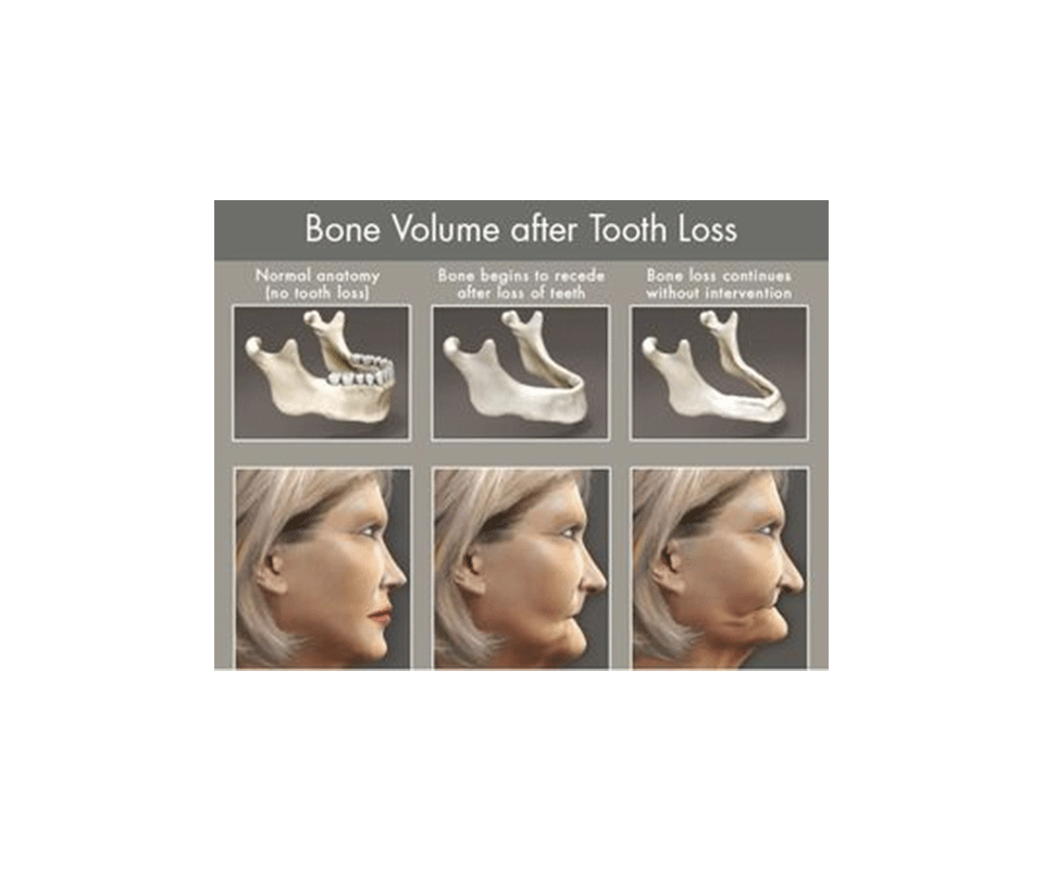 implats bone volum after tooth loss