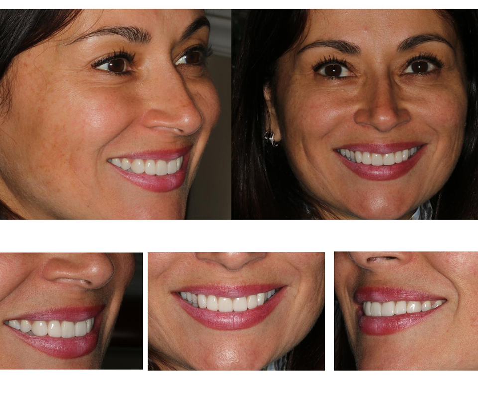 Results of porcelain veneers to fix gap in front teeth