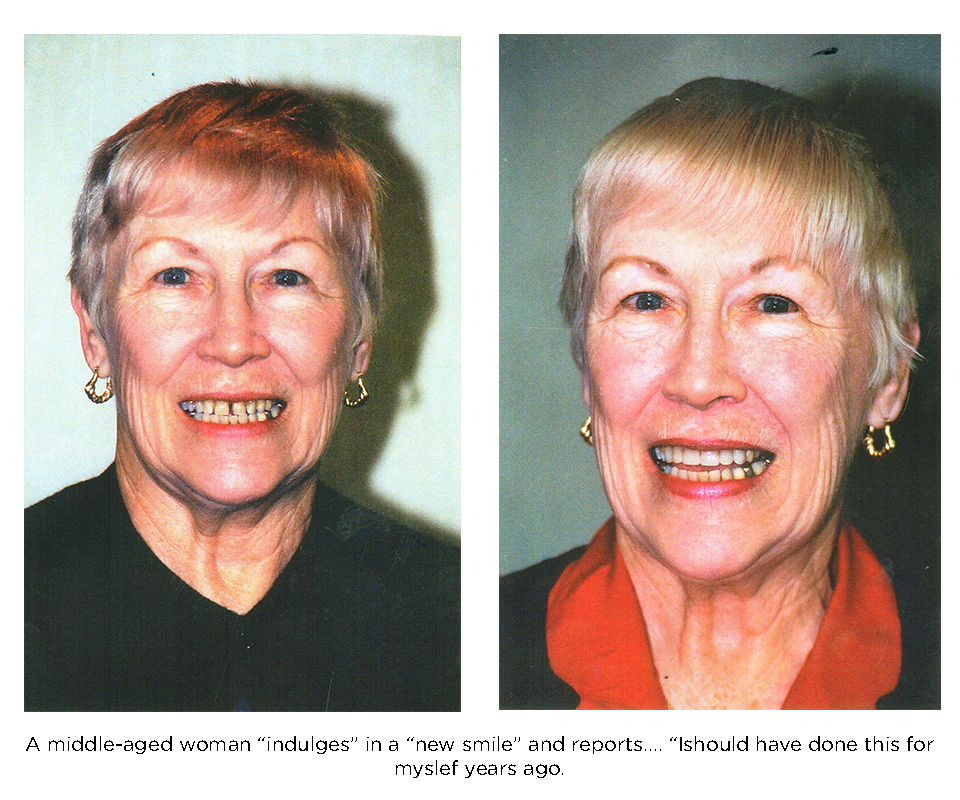 Middle aged woman with a beautiful new smile thanks to the use of porcelain veneers