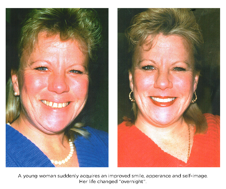 porcelain veneers smile makeover. A young woman suddenly acquieres a new smile