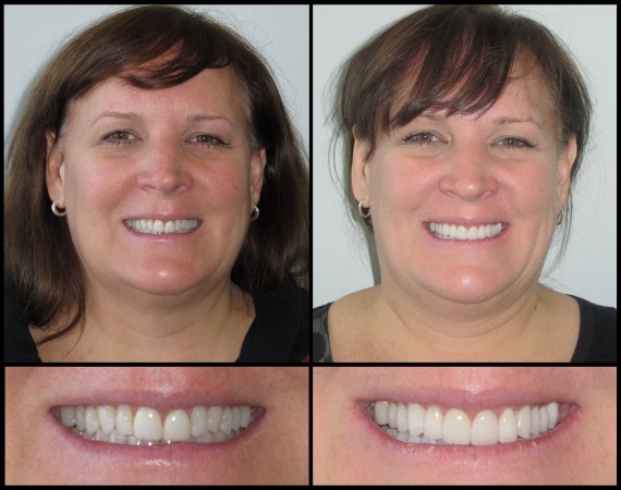 Getting a new smile with dental veneers